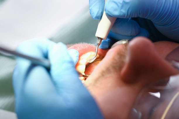 Best Emergency Dental Care for Broken or Chipped Teeth in Emory, VA