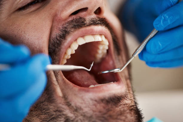 Best Emergency Tooth Extraction in Emory, VA